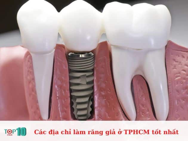 Những địa chỉ làm răng giả tốt nhất