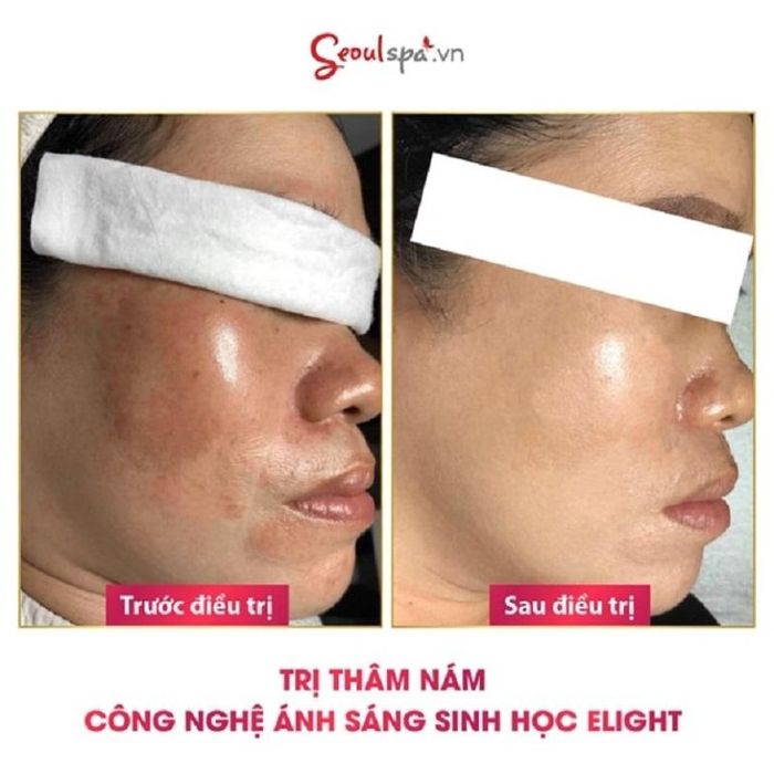 Dịch vụ trị nám trước và sau tại SeoulSpa có hiệu quả như thế nào?