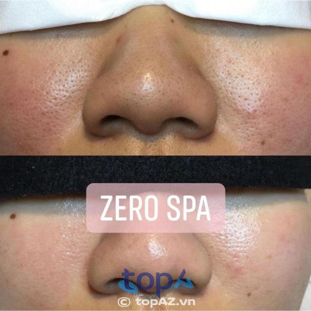 Zero Spa - Đánh bay mụn, tỏa sáng nhan sắc